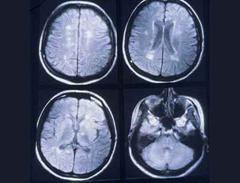 Die neuen Erkenntnisse können evtl. auch bei der Bekämpfung anderer Gehirnerkrankungen helfen.
