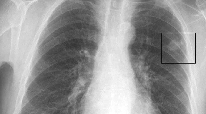 Röntgenbild, auf dem Lungenkrebs zu erkennen ist.